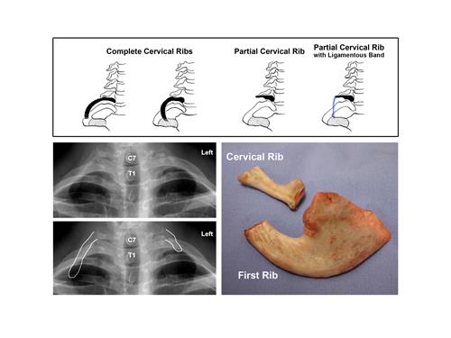 Congenital Variations of TOS | Center for Thoracic Outlet Syndrome