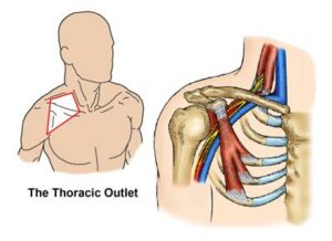 Thoracic Outlet Syndrome - Vascular Services